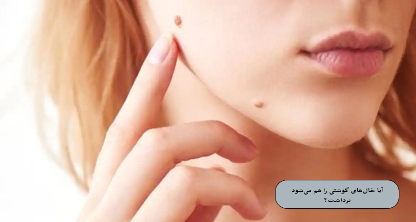 آیا خال‌های گوشتی را هم می‌شود برداشت؟