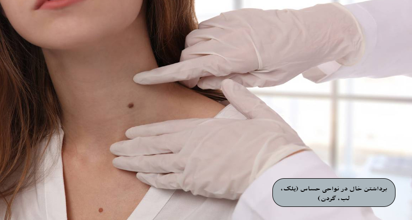برداشتن خال در نواحی حساس (پلک، لب، گردن)