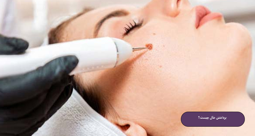 برداشتن خال چیست؟