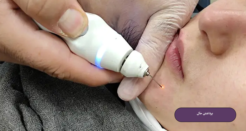 برداشتن خال