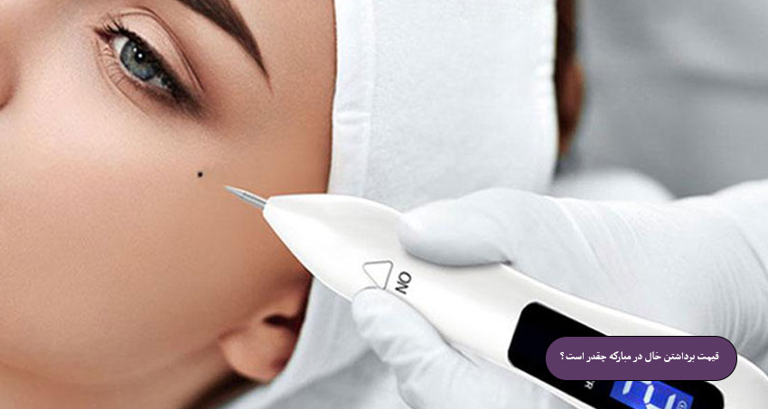 هزینه برداشتن خال در اصفهان