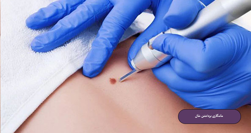 ماندگاری برداشتن خال