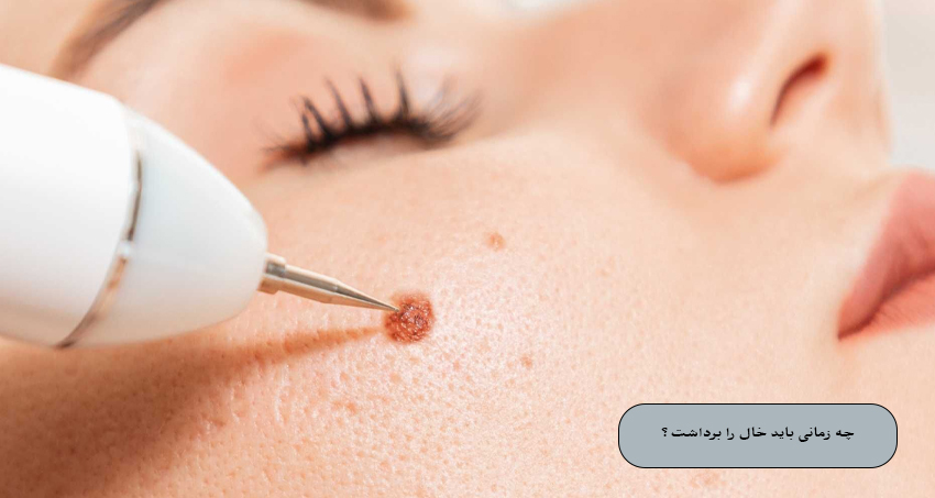 چه زمانی باید خال را برداشت؟