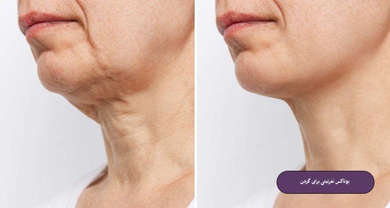 بوتاکس نفرتیتی