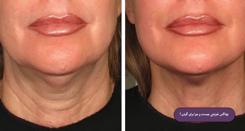 بوتاکس نفرتیتی چیست