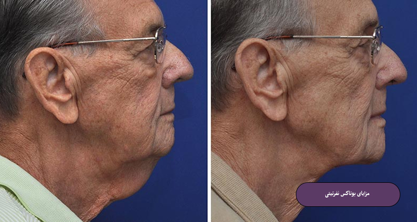 مزایای بوتاکس نفرتیتی