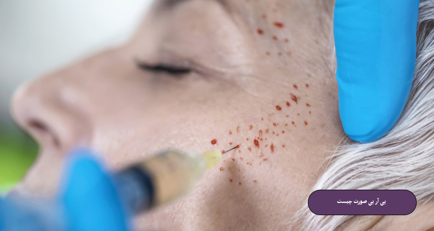 پی آر پی صورت چیست