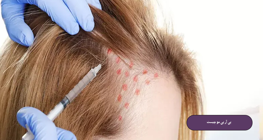 پی آر پی مو چیست