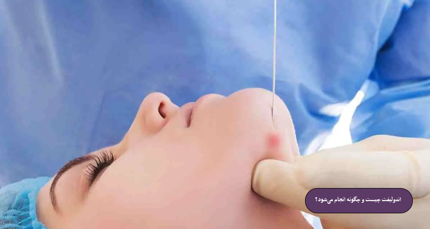 اندولیفت چیست