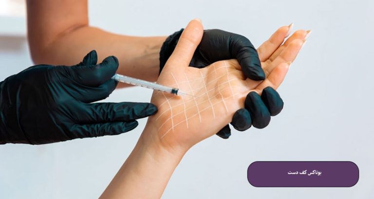 بوتاکس کف دست