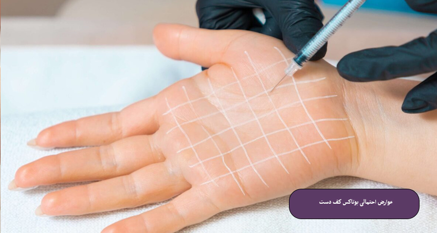 عوارض احتمالی بوتاکس کف دست