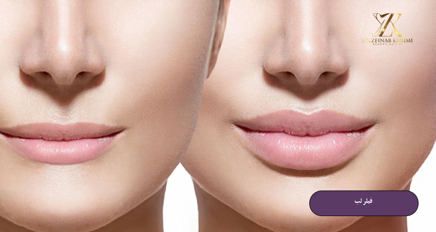 فیلر لب