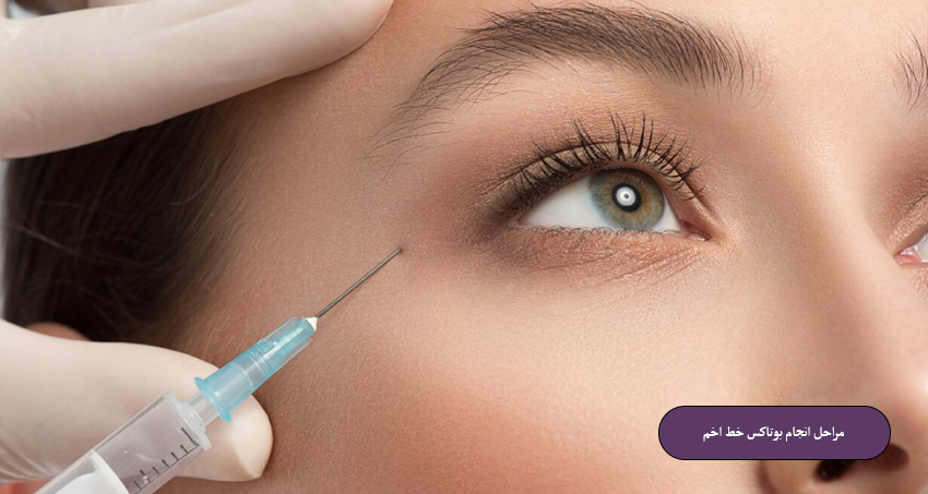 مراحل انجام بوتاکس خط اخم