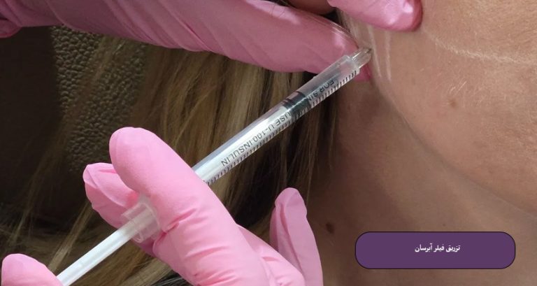 فیلر آبرسان