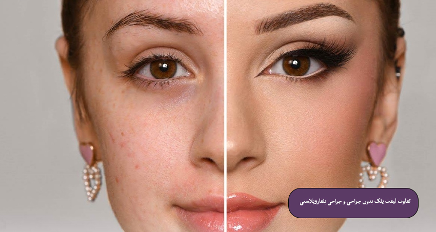 تفاوت لیفت پلک بدون جراحی و جراحی بلفاروپلاستی