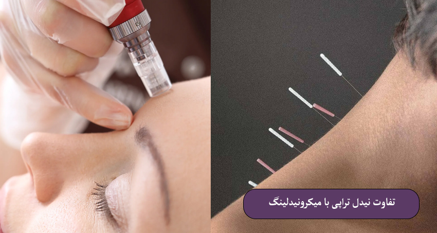 تفاوت نیدل تراپی با میکرونیدلینگ