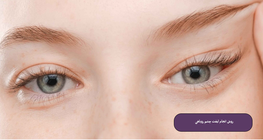 روش انجام لیفت چشم روباهی