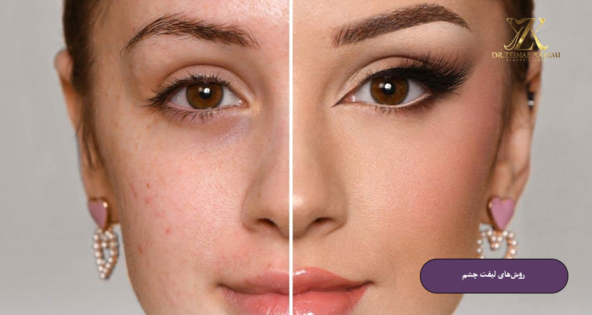 روش‌های لیفت چشم