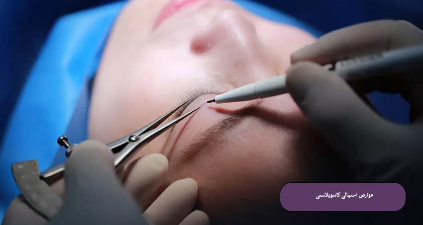 عوارض احتمالی کانتوپلاستی