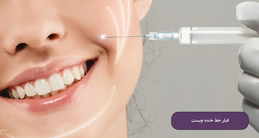 فیلر خط خنده چیست