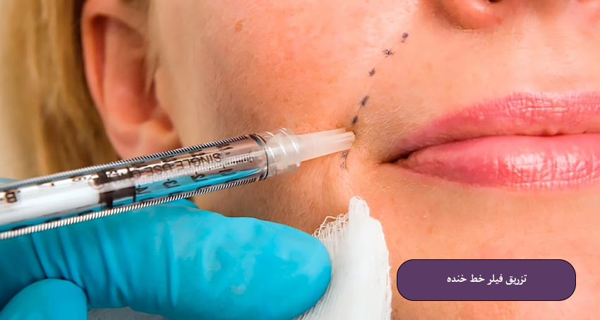 فیلر خط خنده