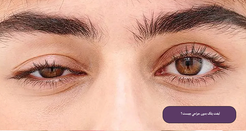 لیفت پلک بدون جراحی چیست