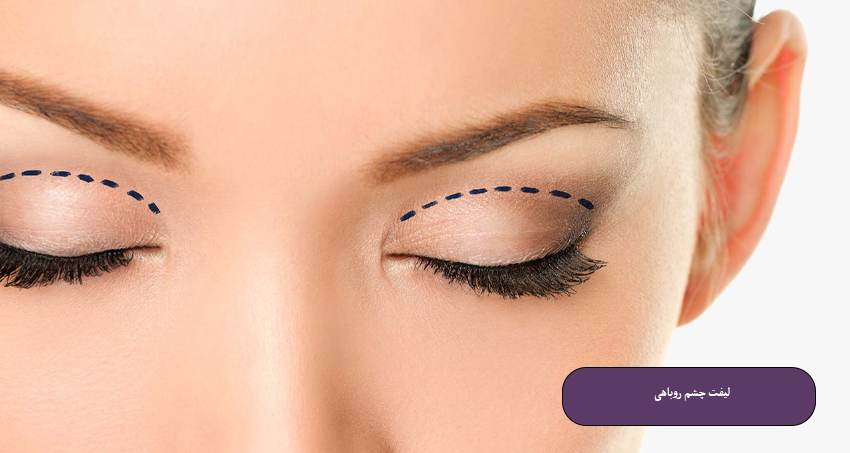 لیفت چشم روباهی