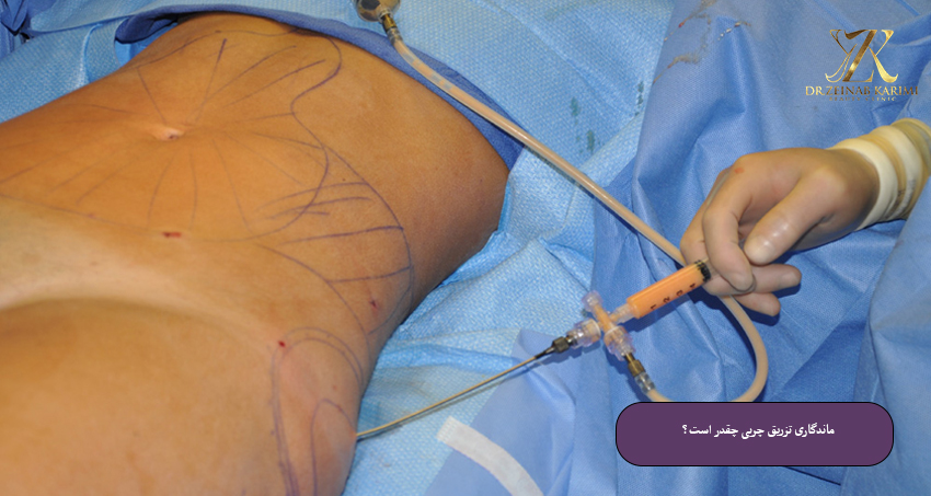 ماندگاری-تزریق-چربی