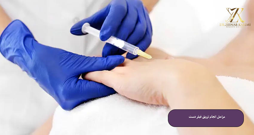 مراحل-انجام-تزریق-فیلر-دست