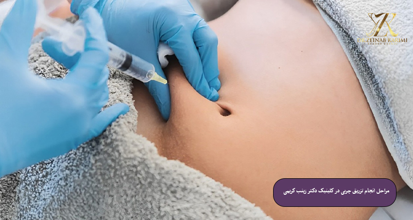 مراحل-انجام-تزریق-چربی-در-کلینیک-دکتر-زینب-کریمی