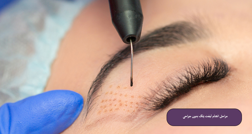 مراحل انجام لیفت پلک بدون جراحی