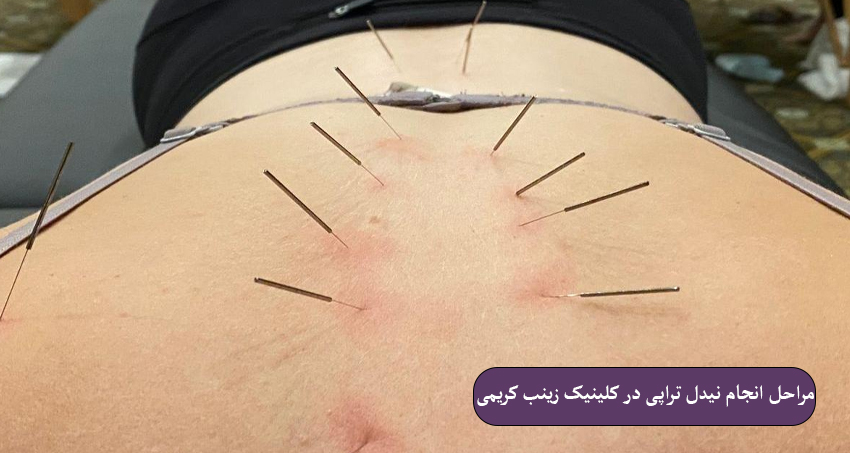 مراحل انجام نیدل تراپی در کلینیک زینب کریمی
