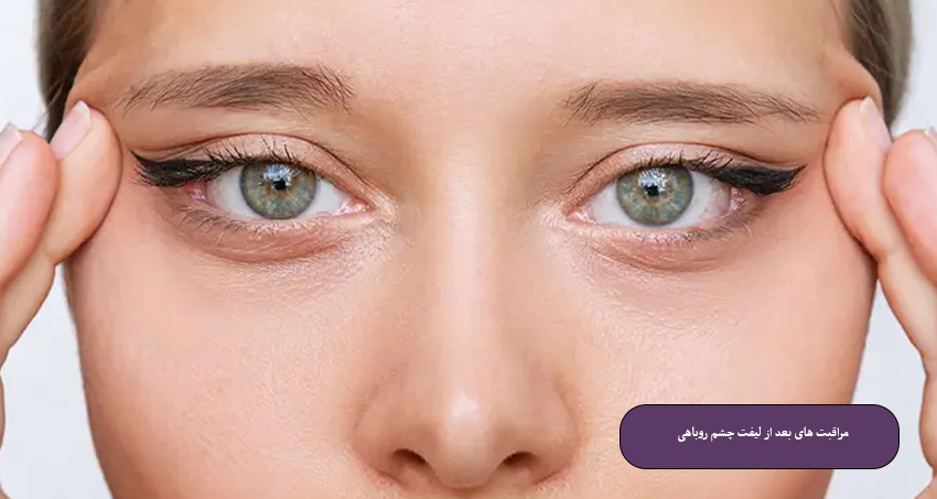 مراقبت‌ های بعد از لیفت چشم روباهی