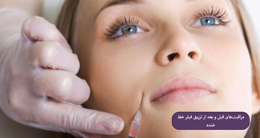 مراقبت‌های قبل و بعد از تزریق فیلر خط خنده