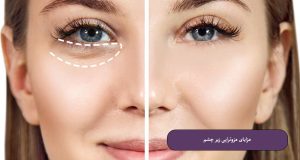 مزایای-مزوتراپی-زیر-چشم