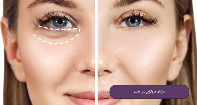 مزایای-مزوتراپی-زیر-چشم