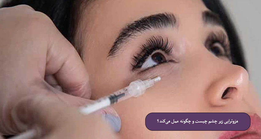 مزوتراپی-زیر-چشم-چیست