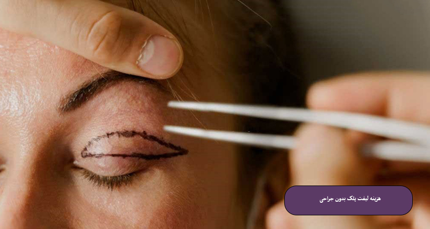 هزینه لیفت پلک بدون جراحی