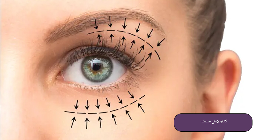 کانتوپلاستی چیست