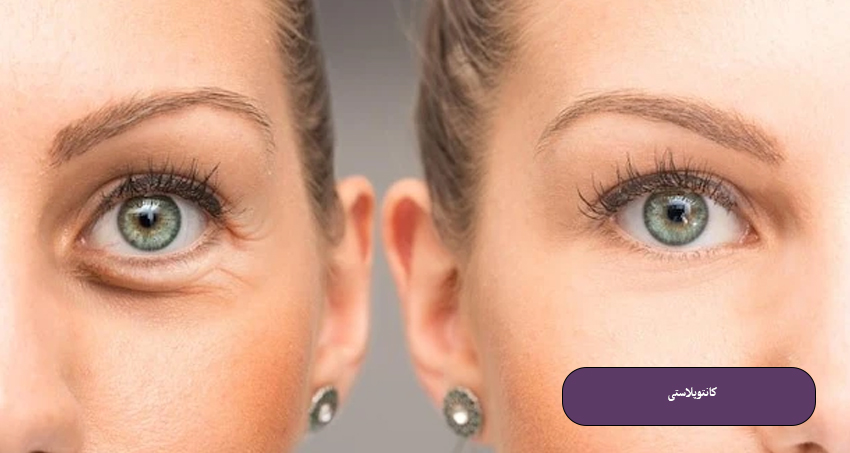 کانتوپلاستی