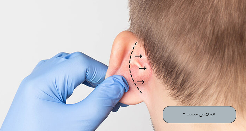 اتوپلاستی چیست؟