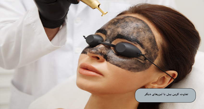 تفاوت کربن پیل با لیزرهای دیگر