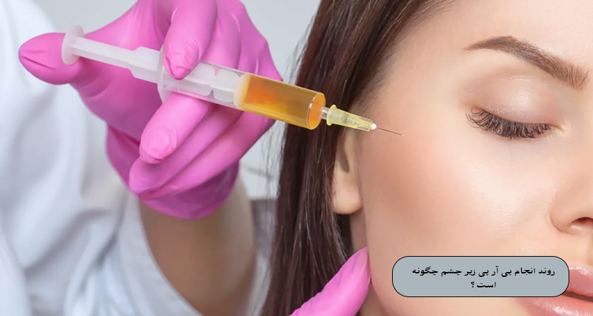 روند انجام پی آر پی زیر چشم چگونه است؟