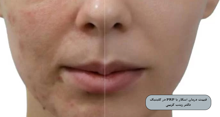 قیمت درمان اسکار با PRP در کلینیک دکتر زینب کریمی