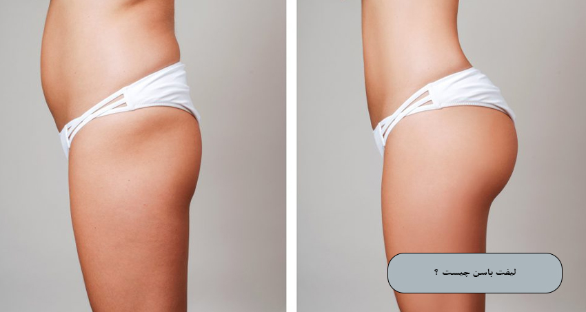 لیفت باسن چیست؟