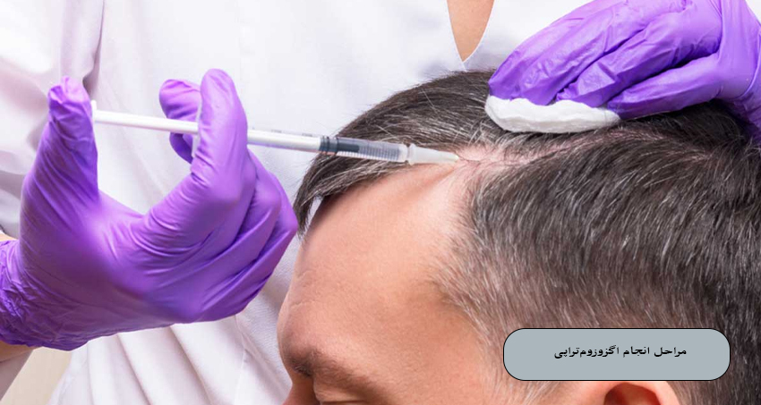 مراحل انجام اگزوزوم‌ تراپی