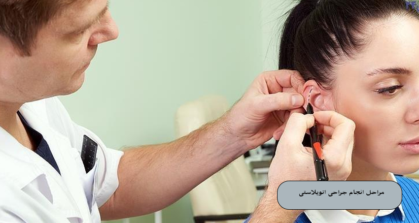 مراحل انجام جراحی اتوپلاستی