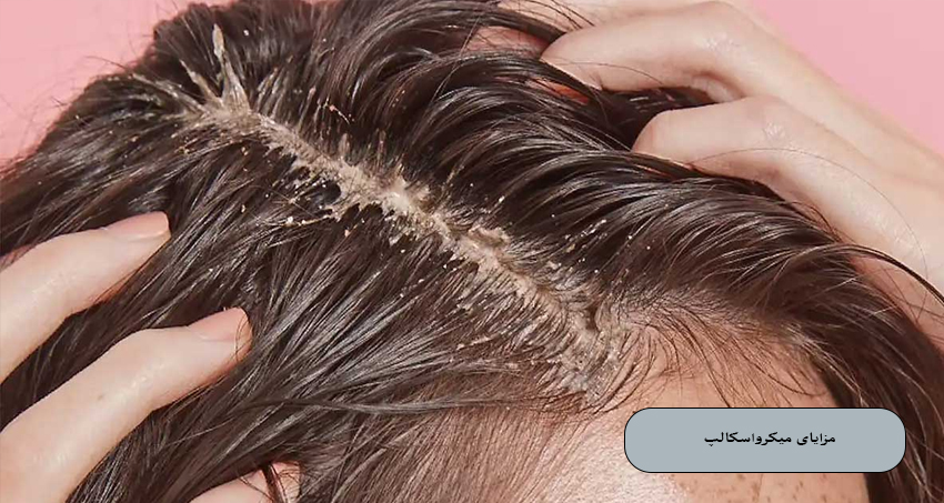 مزایای میکرواسکالپ