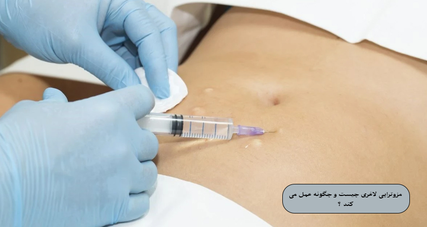 مزوتراپی لاغری چیست و چگونه عمل می ‌کند؟