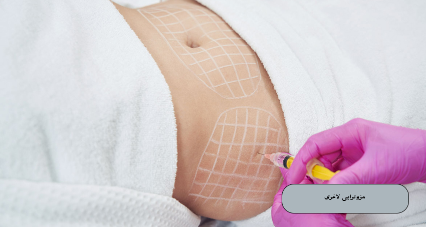 مزوتراپی لاغری